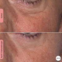 Pure My Skin LED Gesichtsmaske 100