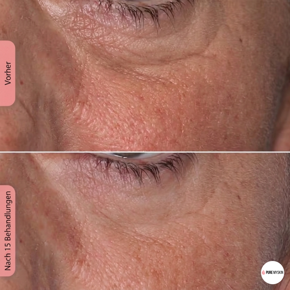 Pure My Skin LED Gesichtsmaske 100