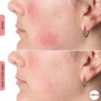 Pure My Skin LED Gesichtsmaske 100