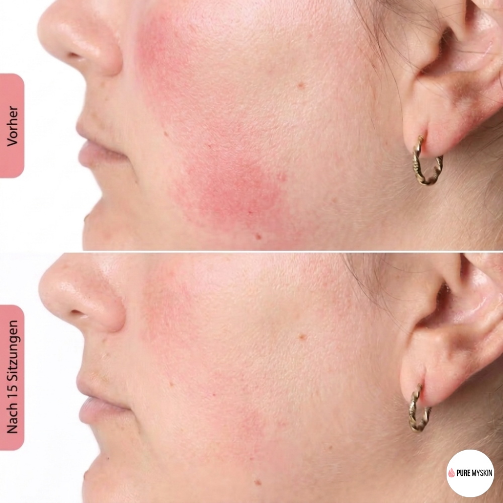 Pure My Skin LED Gesichtsmaske 100